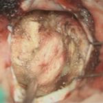 No.’26_18　摘出 後