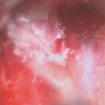 No.’26_23　摘出 前