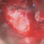 No.’26_23　 摘出 中