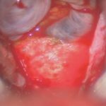 No.’26_23　摘出 後