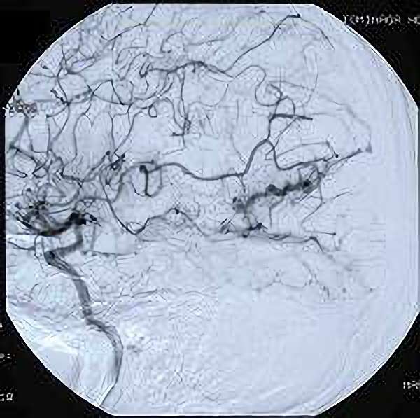 手術前（脳血管撮影画像）1