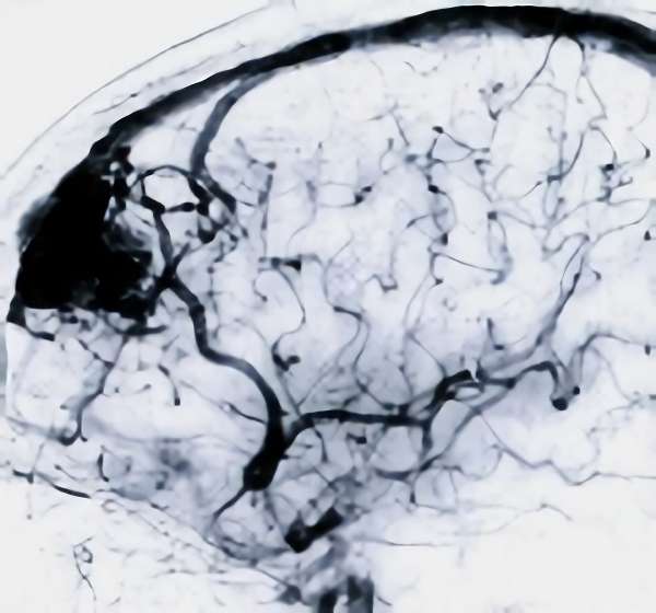 手術前（脳血管撮影画像）3