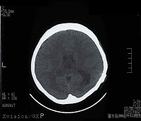 手術後（脳血管撮影画像）3