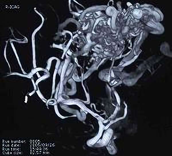 手術前（脳血管撮影画像）4