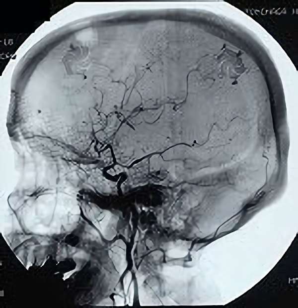 手術後（脳血管撮影画像）2
