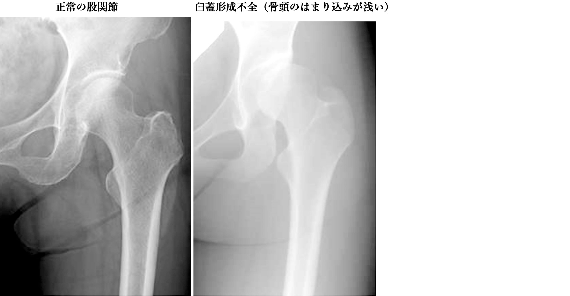先天性股関節脱臼の症状は何ですか?