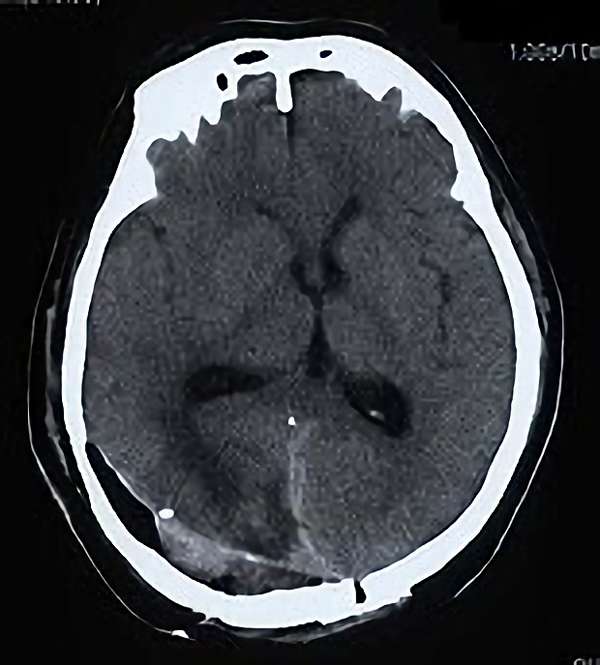 手術後（脳血管撮影画像）3