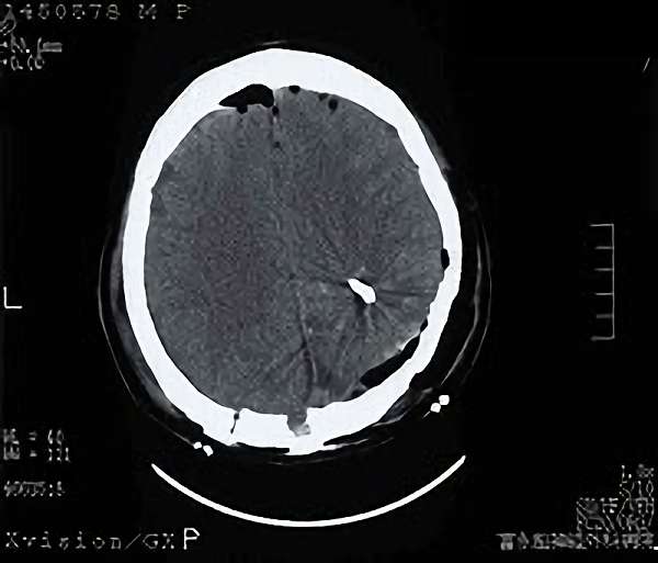 手術後（脳血管撮影画像）4