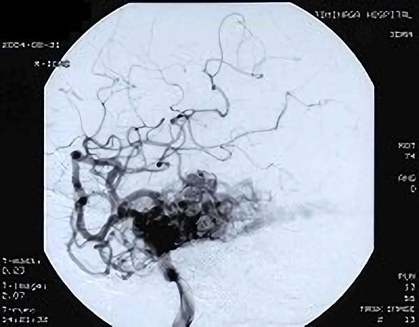 手術前（脳血管撮影画像）2
