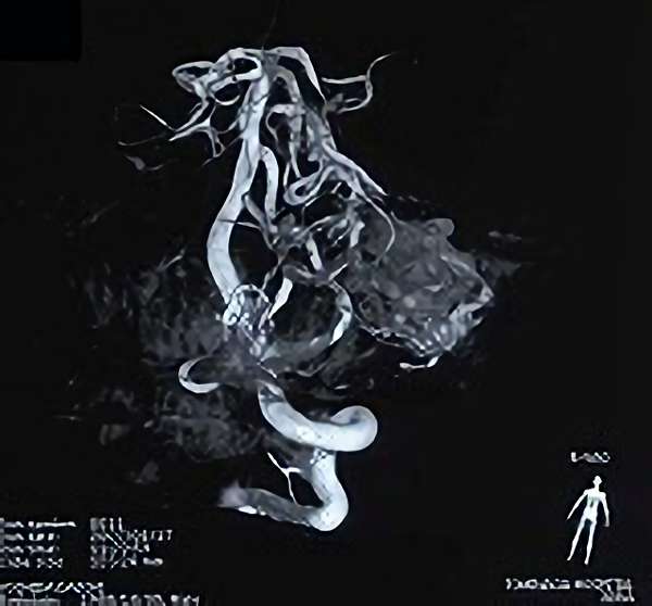 手術前（脳血管撮影画像）5