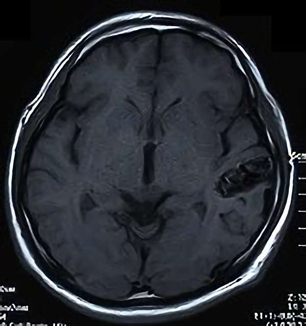 手術前（脳血管撮影画像）3