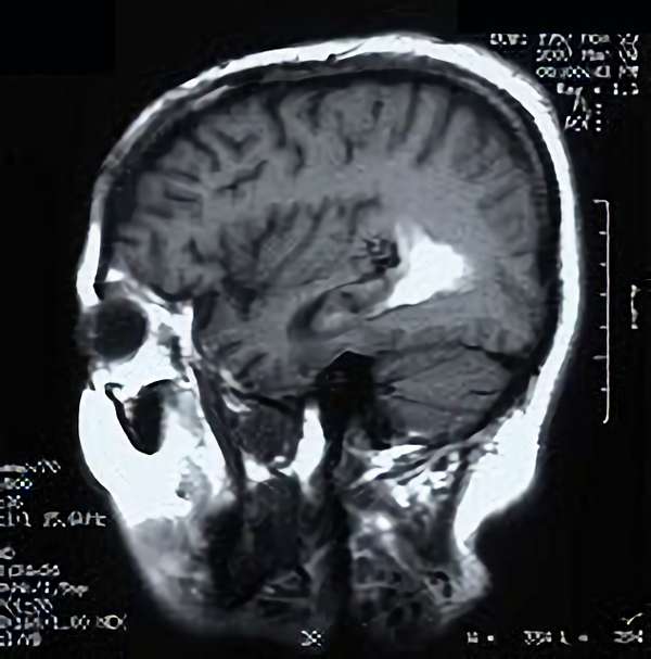 手術前（脳血管撮影画像）4