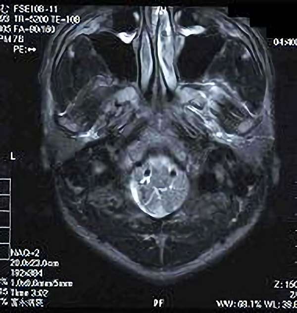 手術後（脳血管撮影画像）2